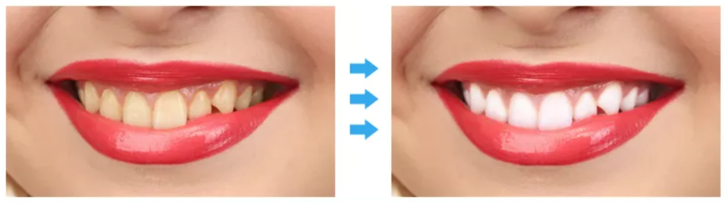 Gel Teeth Whitening Refill Pen - Image 3